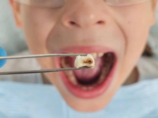 Best Emergency Dental Services for Seniors in Covington, VA